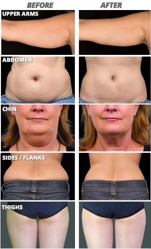 Fat Reduction Without Surgery With CoolSculpting - RL Center